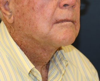 Male \"Turkey Gobbler\" Neck Lift - after - oblique