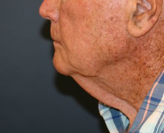 Male \"Turkey Gobbler\" Neck Lift - before - front