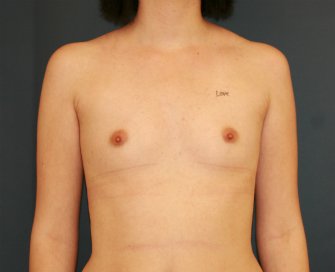 Breast Augmentation 650cc - before - front