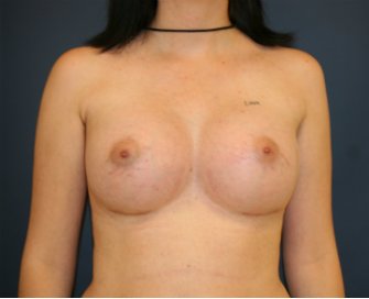Breast Augmentation 650cc - after - front