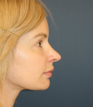 Revision Rhinoplasty 82 - before - front