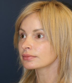 Revision Rhinoplasty 82 - before - oblique