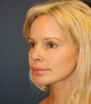 Revision Rhinoplasty 82 - after - oblique