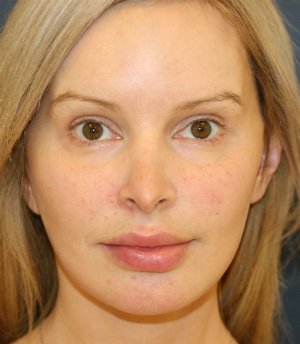 Revision Rhinoplasty 82 - before - side