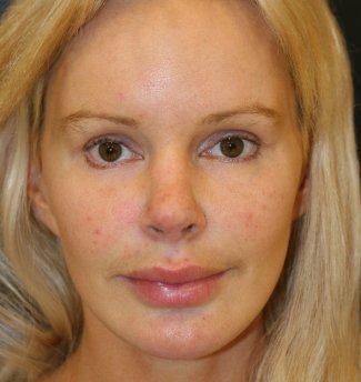 Revision Rhinoplasty 82 - after - side