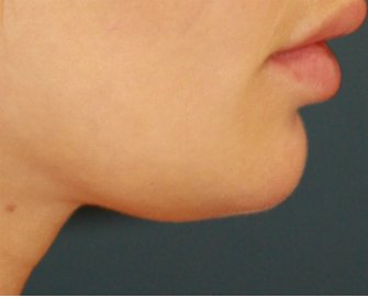 Liposuction fat under chin - before - front