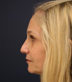 Rhinoplasty-San-Diego 224 - before - front