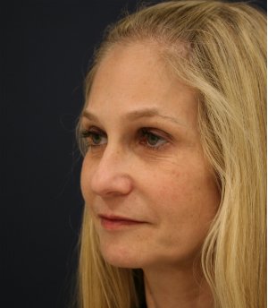 Rhinoplasty-San-Diego 224 - before - oblique
