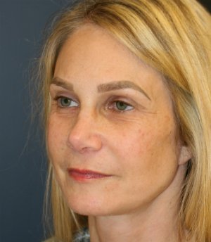 Rhinoplasty-San-Diego 224 - after - oblique