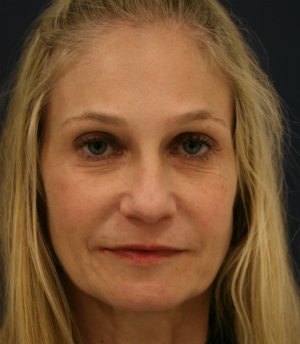 Rhinoplasty-San-Diego 224 - before - side