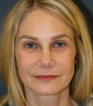 Rhinoplasty-San-Diego 224 - after - side