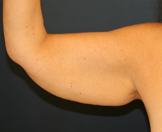 Arm Lift San Diego 27 - before - front