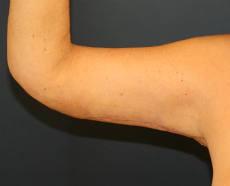 Arm Lift San Diego 27 - after - front