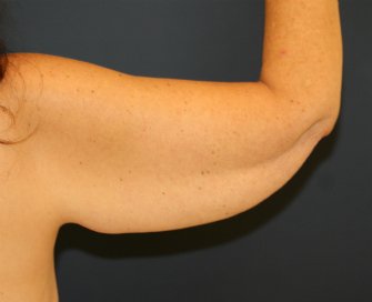 Arm Lift San Diego 27 - before - back