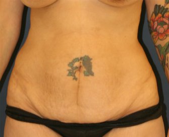 Tummy Tuck 118 - before - front