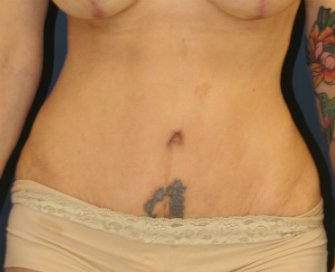 Tummy Tuck 118 - after - front