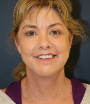 Lower Face & Neck 47 - after - front