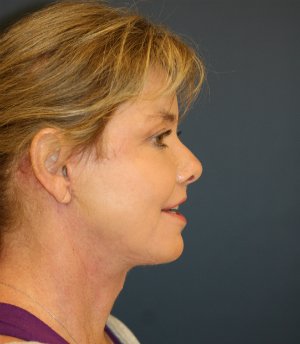 Neck Lift San Diego 38 - after - front
