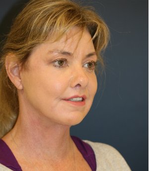 Neck Lift San Diego 38 - after - oblique