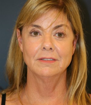 Neck Lift San Diego 38 - before - side