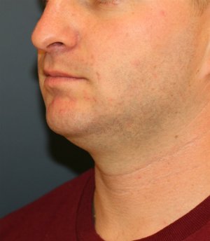 chin implant neck lipo - before - oblique