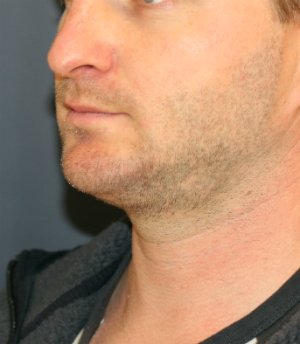 chin implant neck lipo - after - oblique