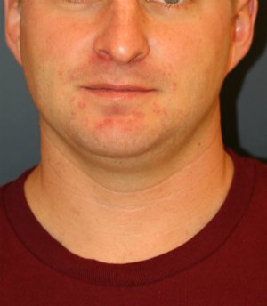 chin implant neck lipo - before - side