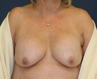 Breast sagging and contracture - before - front