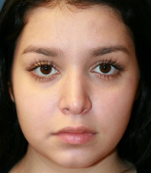 Tip Rhinoplasty in Office - before - front