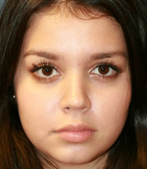 Tip Rhinoplasty in Office - after - front