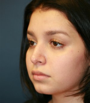 Tip Rhinoplasty in Office - before - oblique