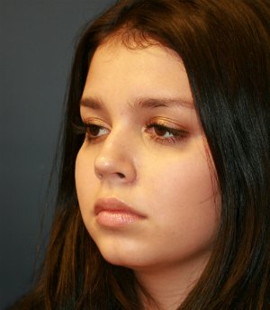 Tip Rhinoplasty in Office - after - oblique