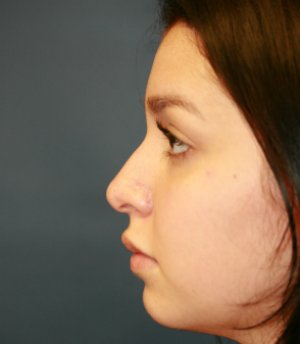 Tip Rhinoplasty in Office - before - side