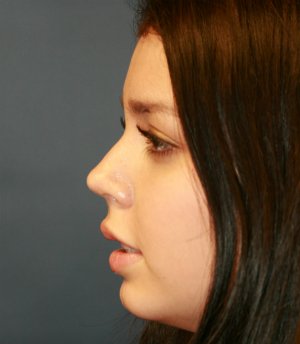 Tip Rhinoplasty in Office - after - side