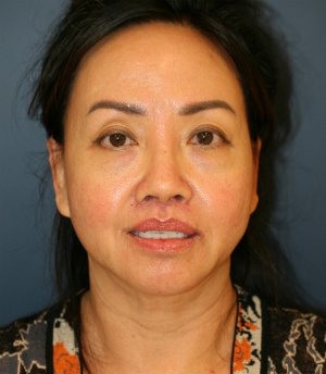 Face, Neck, Eyes - before - front