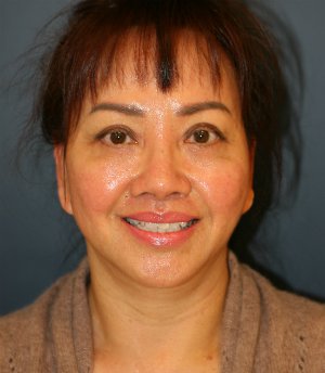 Face, Neck, Eyes - after - front