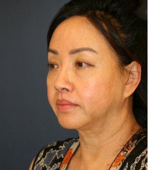 Face, Neck, Eyes - before - oblique