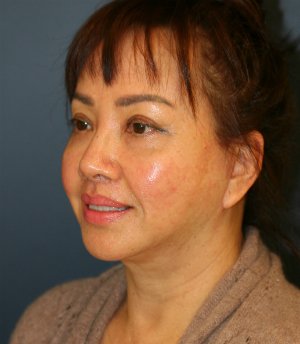 Face, Neck, Eyes - after - oblique