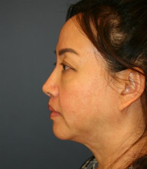 Face, Neck, Eyes - before - side