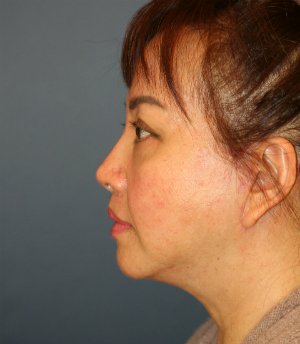 Face, Neck, Eyes - after - side