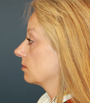 Face Lift San Diego 50 - before - side