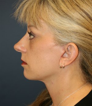 Face Lift San Diego 50 - after - side