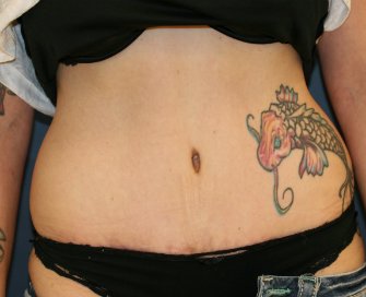 Tummy Tuck San Diego 119 - after - front