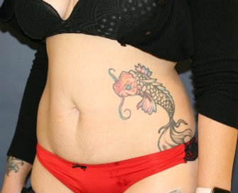 Tummy Tuck San Diego 119 - before - oblique