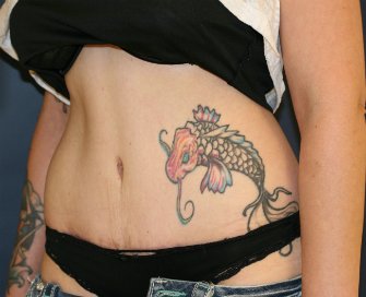 Tummy Tuck San Diego 119 - after - oblique