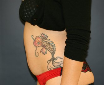 Tummy Tuck San Diego 119 - before - side