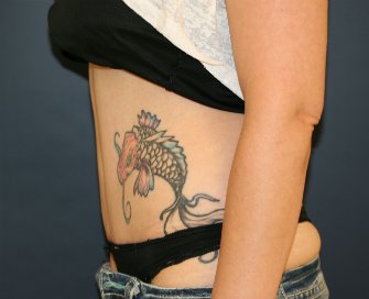 Tummy Tuck San Diego 119 - after - side
