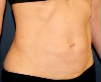 Tummy Tuck San Diego 120 - before - front