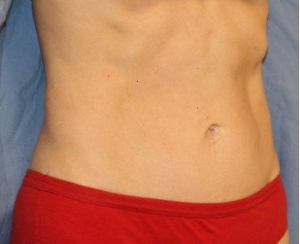 Tummy Tuck San Diego 120 - after - front