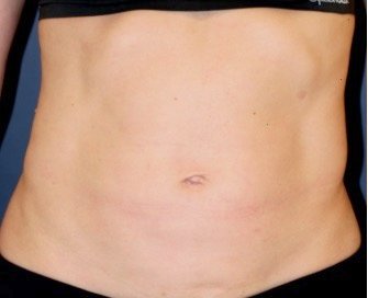 Tummy Tuck San Diego 120 - before - oblique